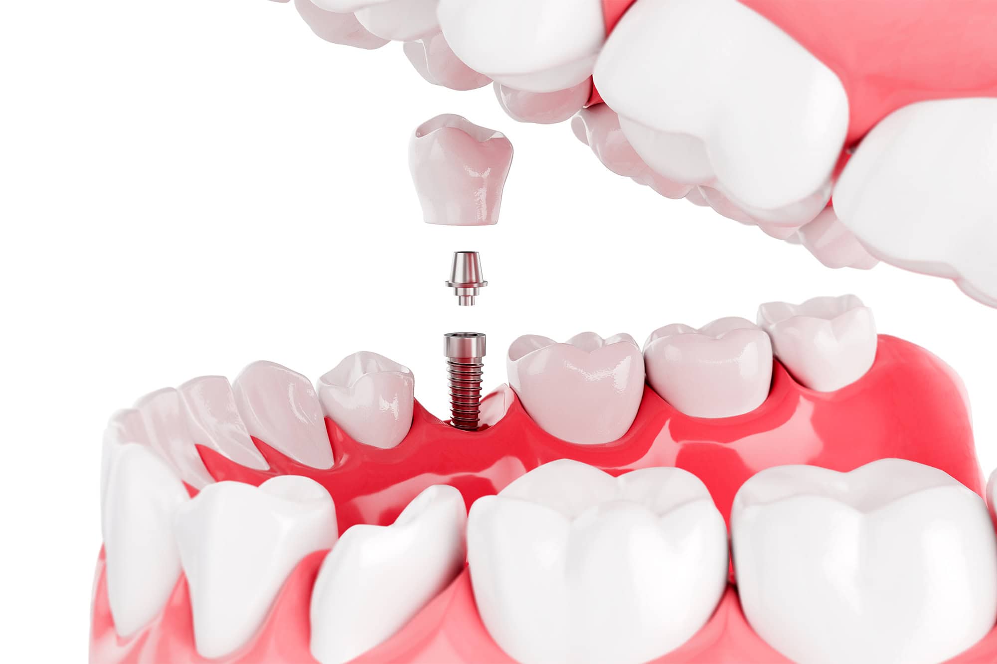 Close up Process Implants teeth health care on white background.