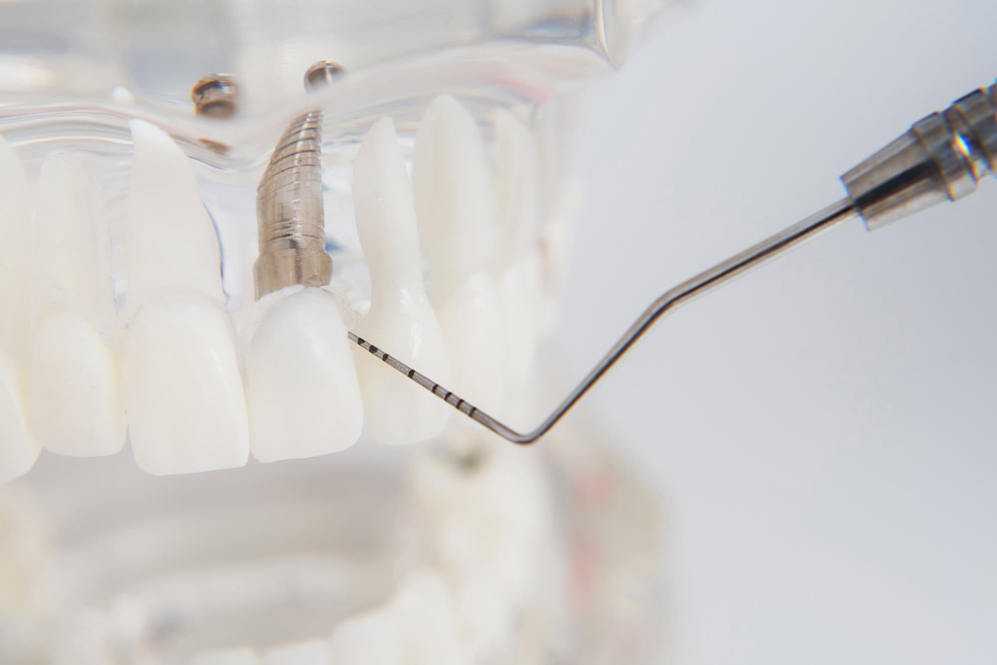 Close up Process Implants teeth health care on white background.