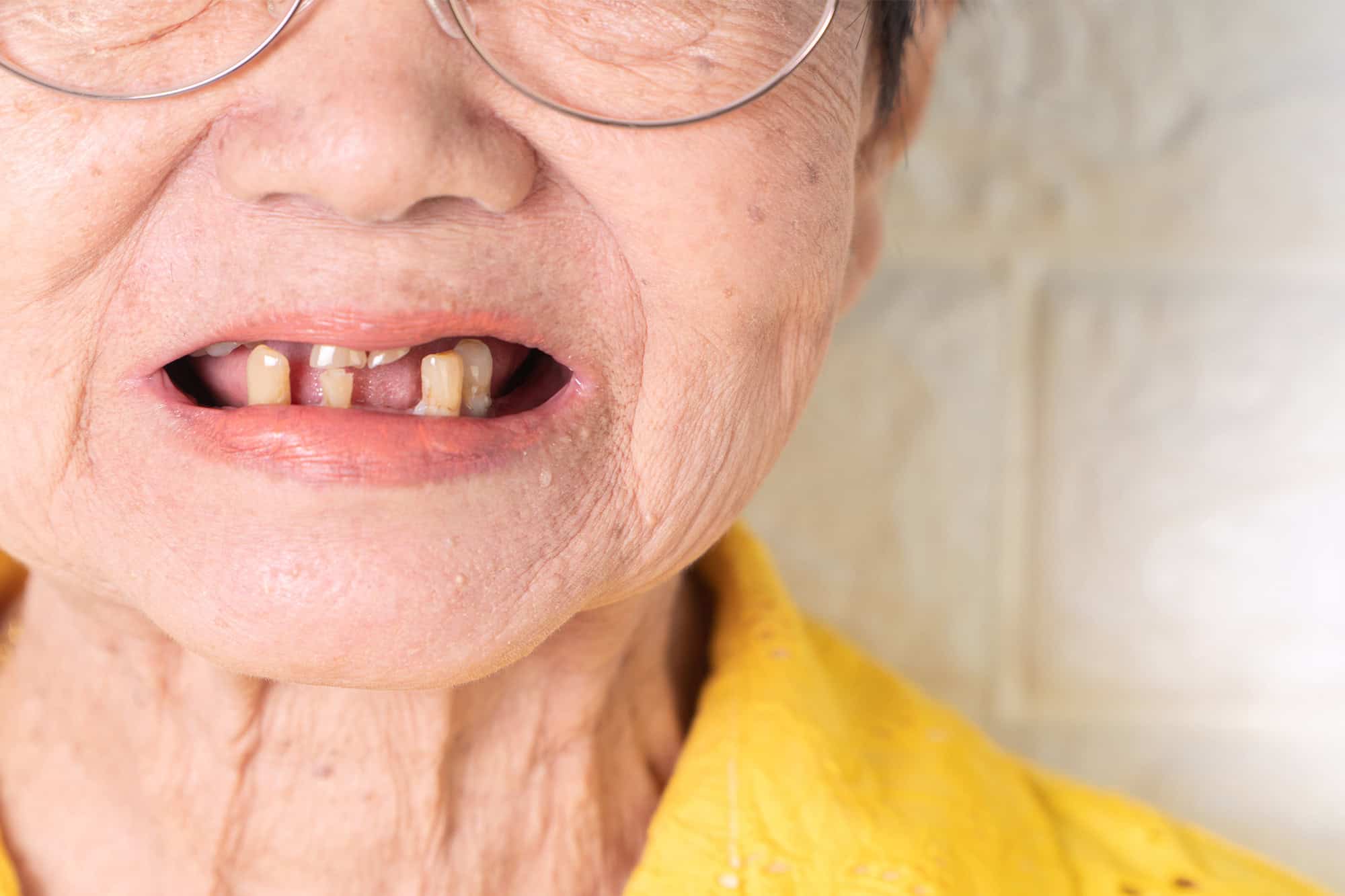 Close up Process Implants teeth health care on white background.